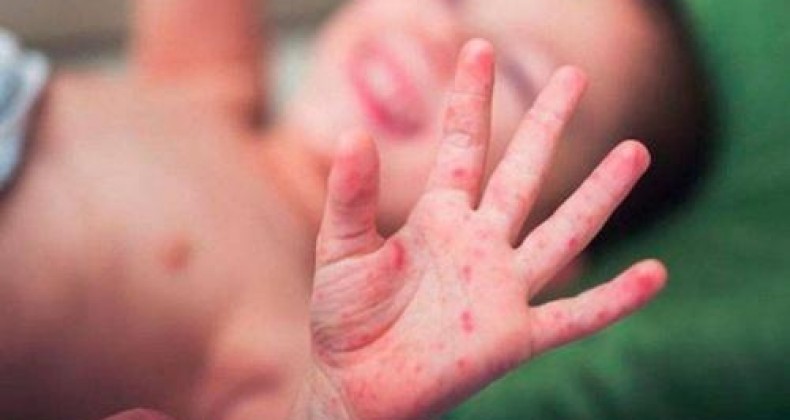 Escolas de Chapecó enfrentam surto de doença ‘mão-pé-boca’