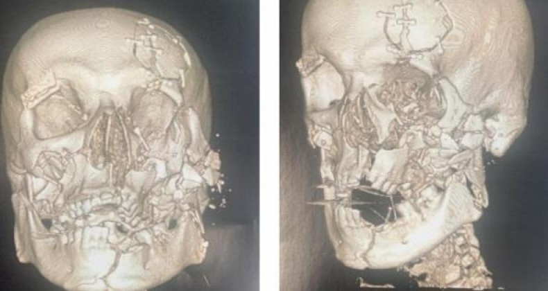 Tatuagem revela identidade de morador que teve rosto desfigurado